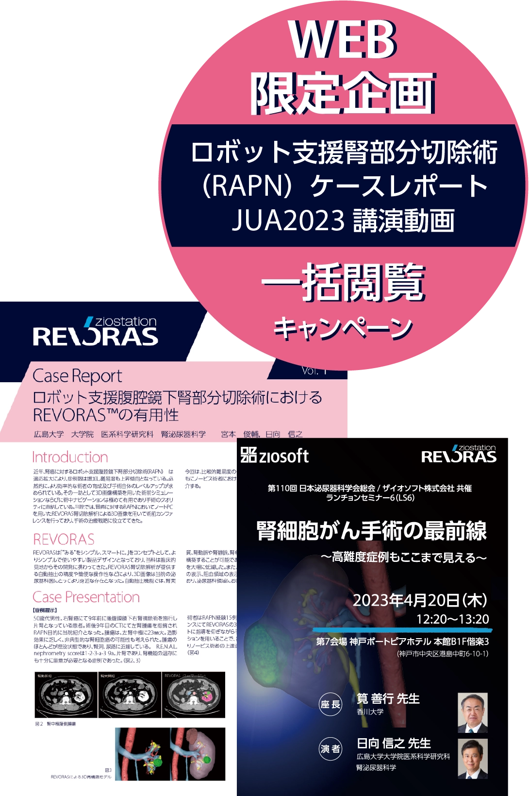 WEB限定企画 ロボット支援腎切除手術（RAPN）ケースレポート/JUA2023 講演動画 一括閲覧キャンペーン