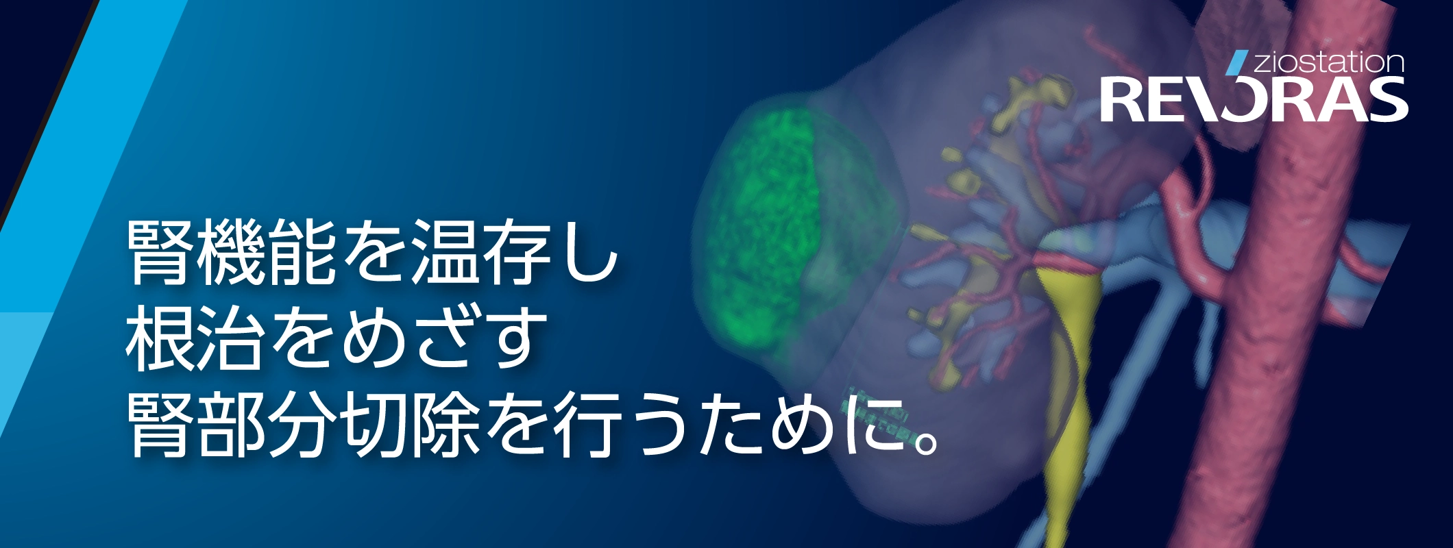Ziostation REVORAS 腎機能を温存し根治をめざす腎部分切除を行うために。