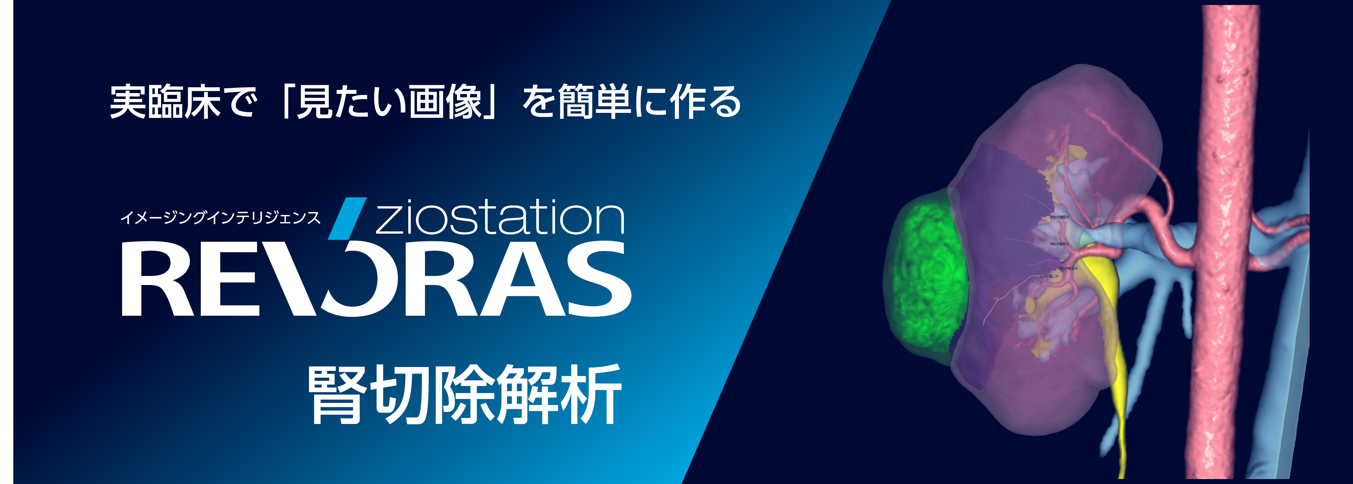 実臨床で「見たい画像」を簡単に作る　イメージングインテリジェンス　ziostation REVORAS 腎切除解析